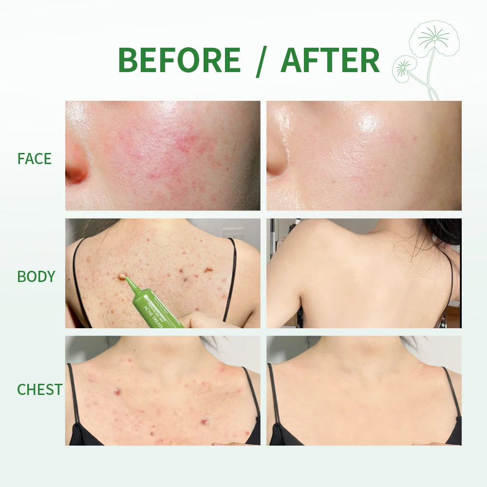 Acne Removal Balm Effective Fade Acne Spots Repair Gel Oil