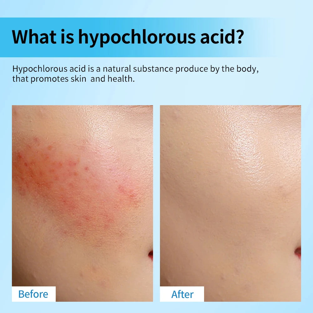 Hypochlorous Acid Facial Spray Reduce redness swelling acne Versatile